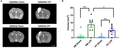 BDNF Val66Met Genetic Polymorphism Results in Poor Recovery Following Repeated Mild Traumatic Brain Injury in a Mouse Model and Treatment With AAV-BDNF Improves Outcomes